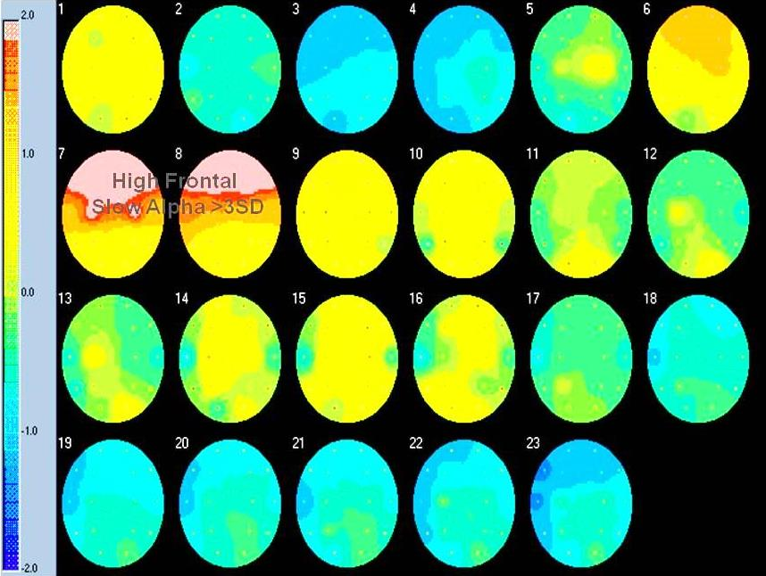 QEEG agytérkép ADD-diagnózisnál: előtte magas frontális lassú alfa, utána normalizált alfa