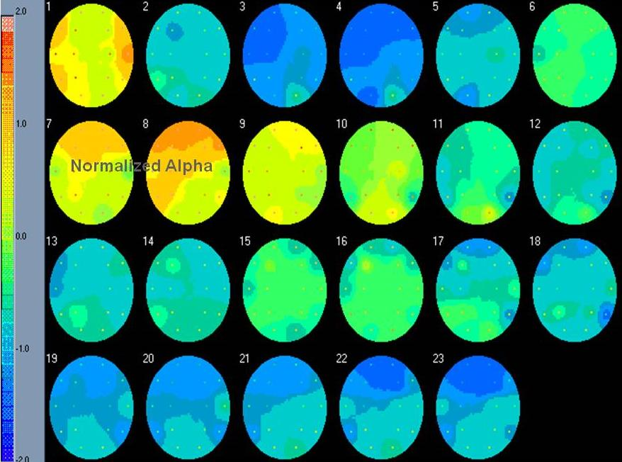 QEEG agytérkép ADD-diagnózisnál: előtte magas frontális lassú alfa, utána normalizált alfa