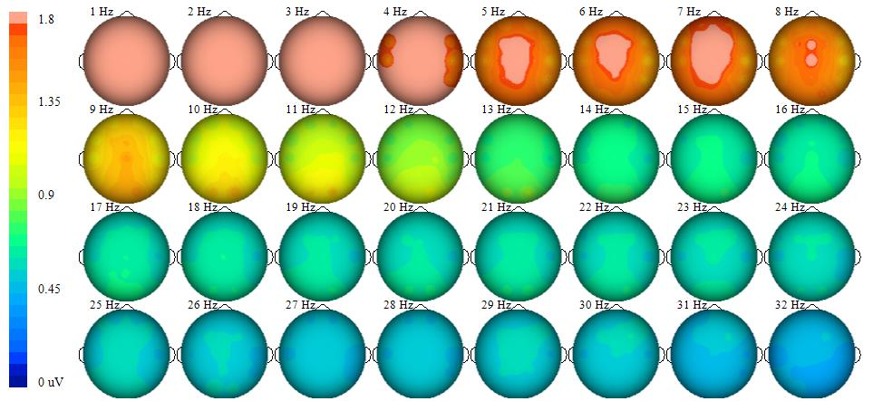 qEEG agytérkép ADHD-ban – frontális théta dominancia, Siever (2016)